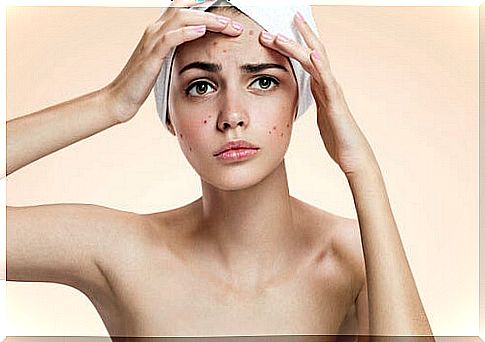 5 home remedies to fight acne