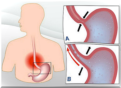 7 natural remedies for heartburn and acid reflux