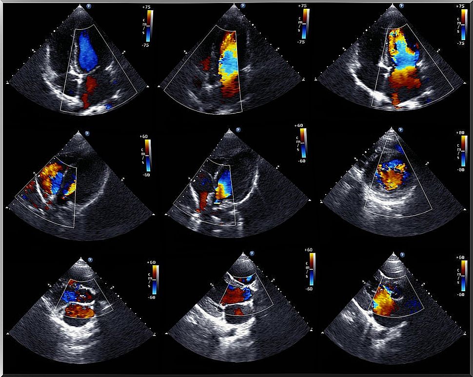 Echocardiogram