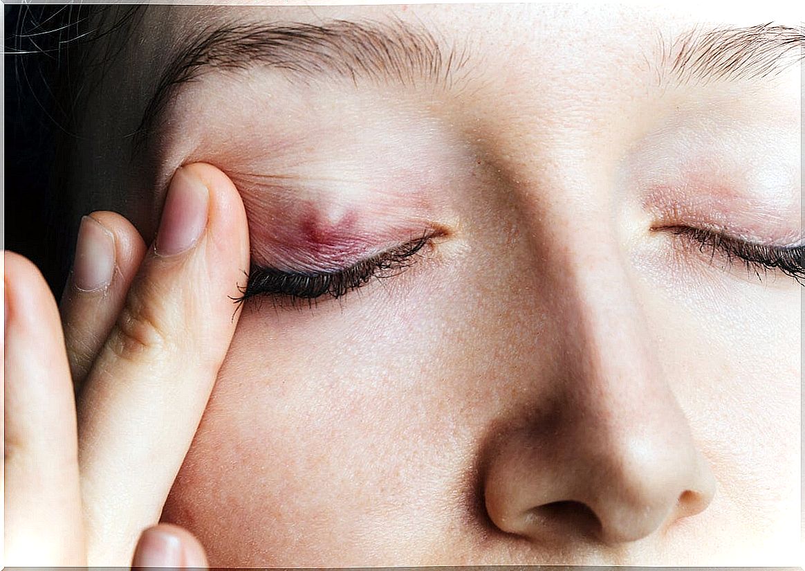 Chalazion: everything you need to know