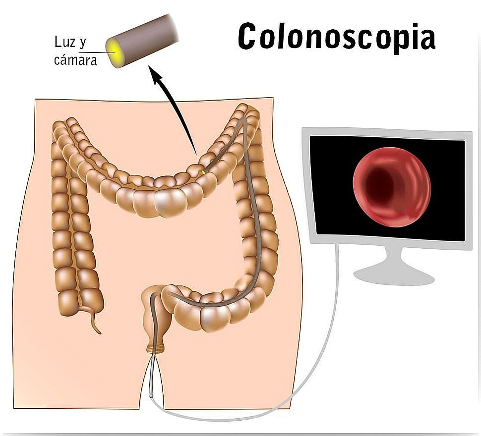 Colonoscopy to analyze the colon