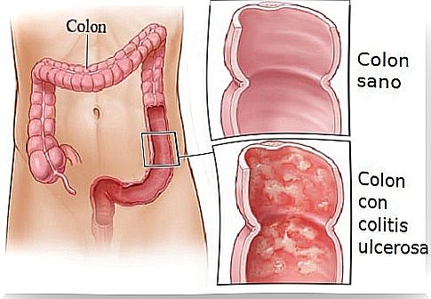 Home treatments for ulcerative colitis