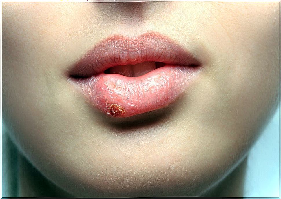 herpes labialis