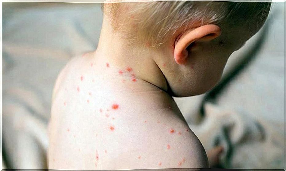 Child with measles