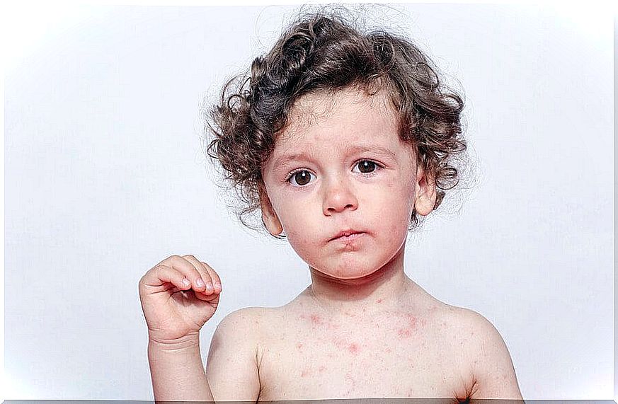 Child with measles spots