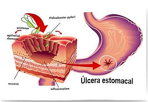 Natural treatments to fight Helicobacter Pylori bacteria