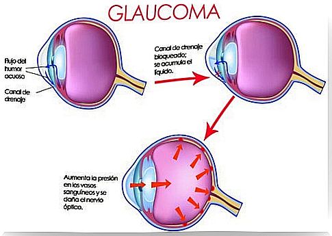 Glaucoma