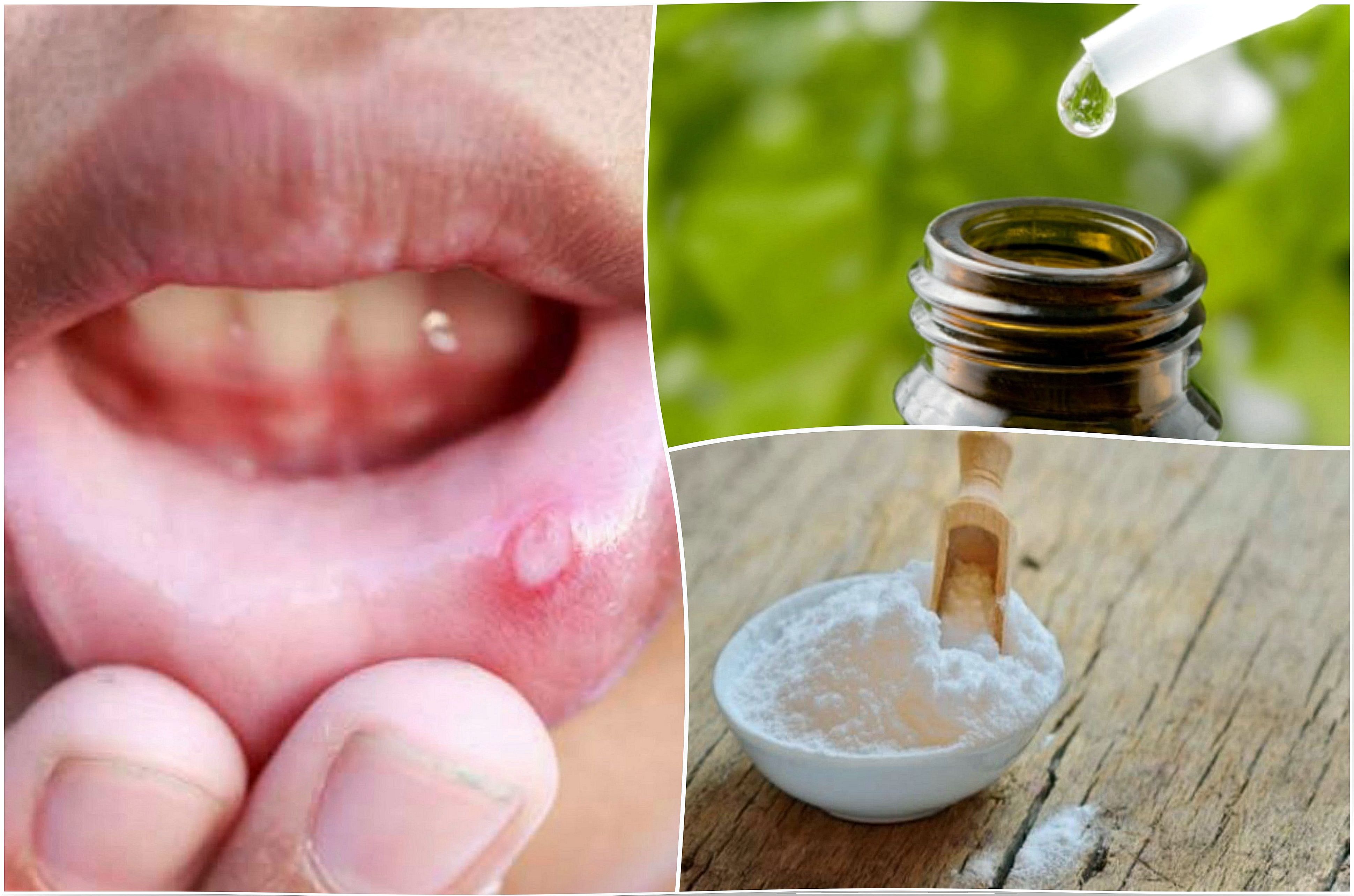 Relieve canker sores using these 6 natural remedies