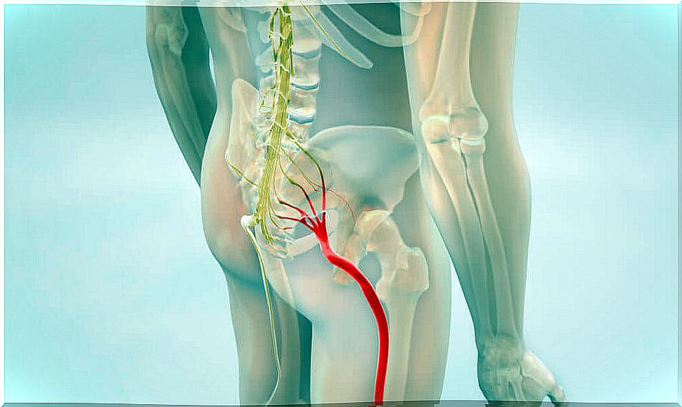 Sciatica pain