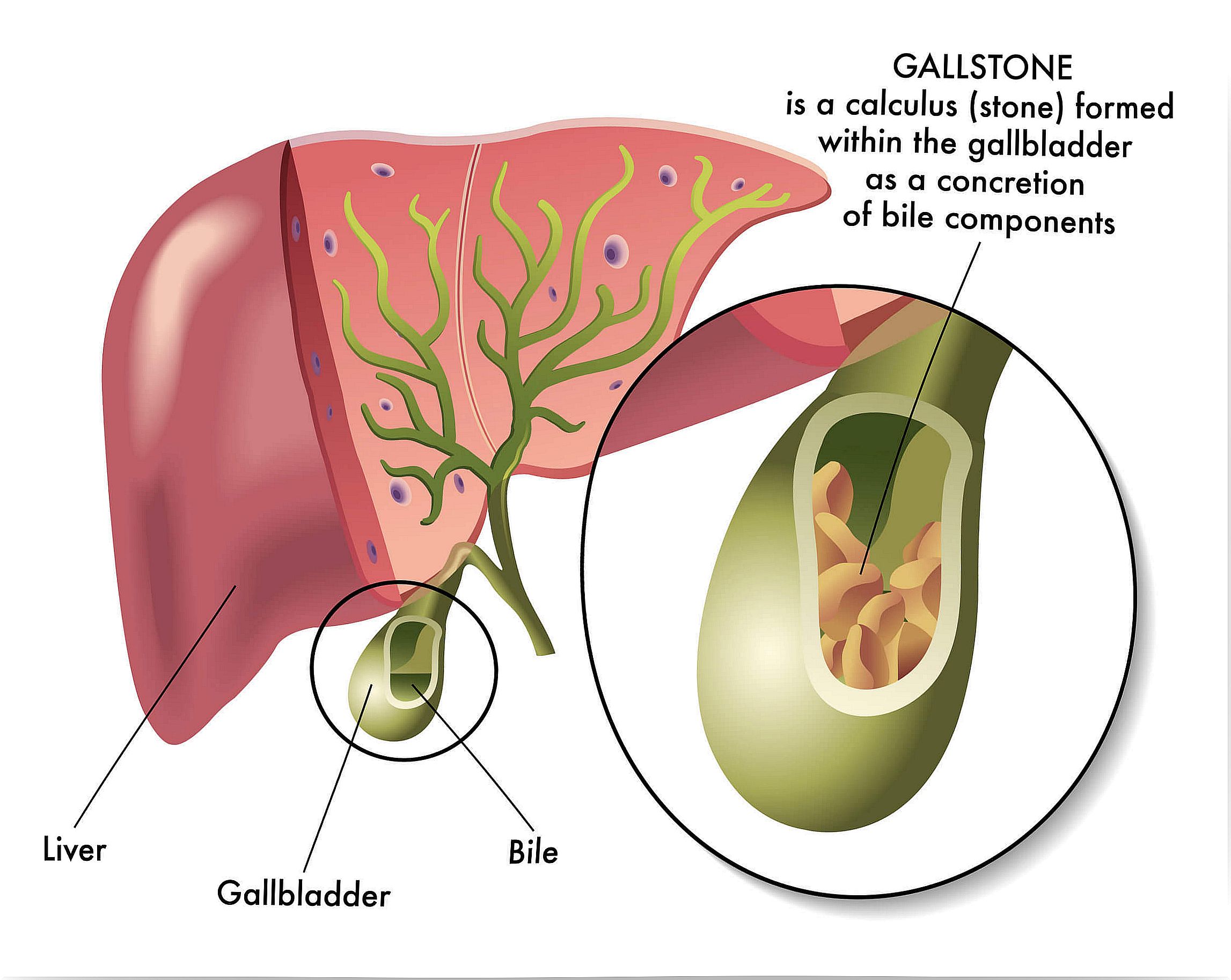 Gallstones are complex.