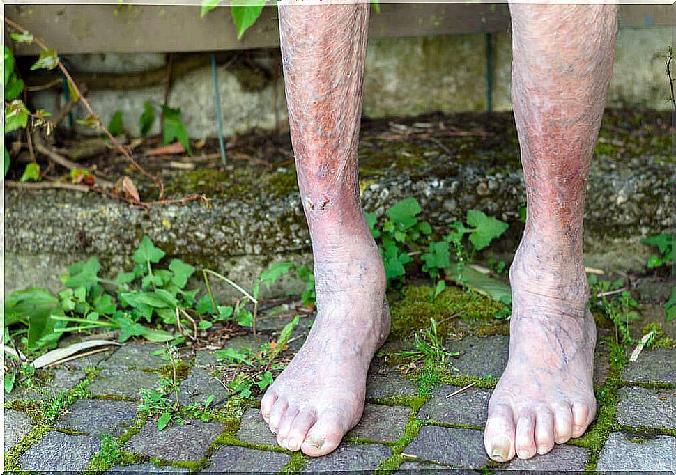 What is cyanosis?