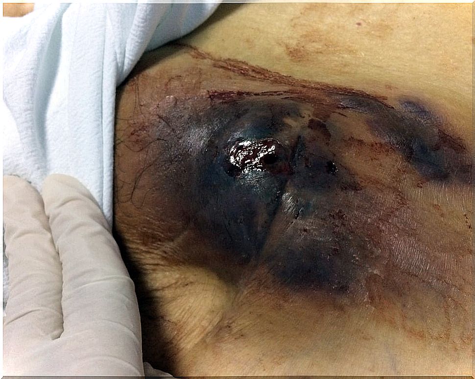 Sepsis caused by cyanosis.