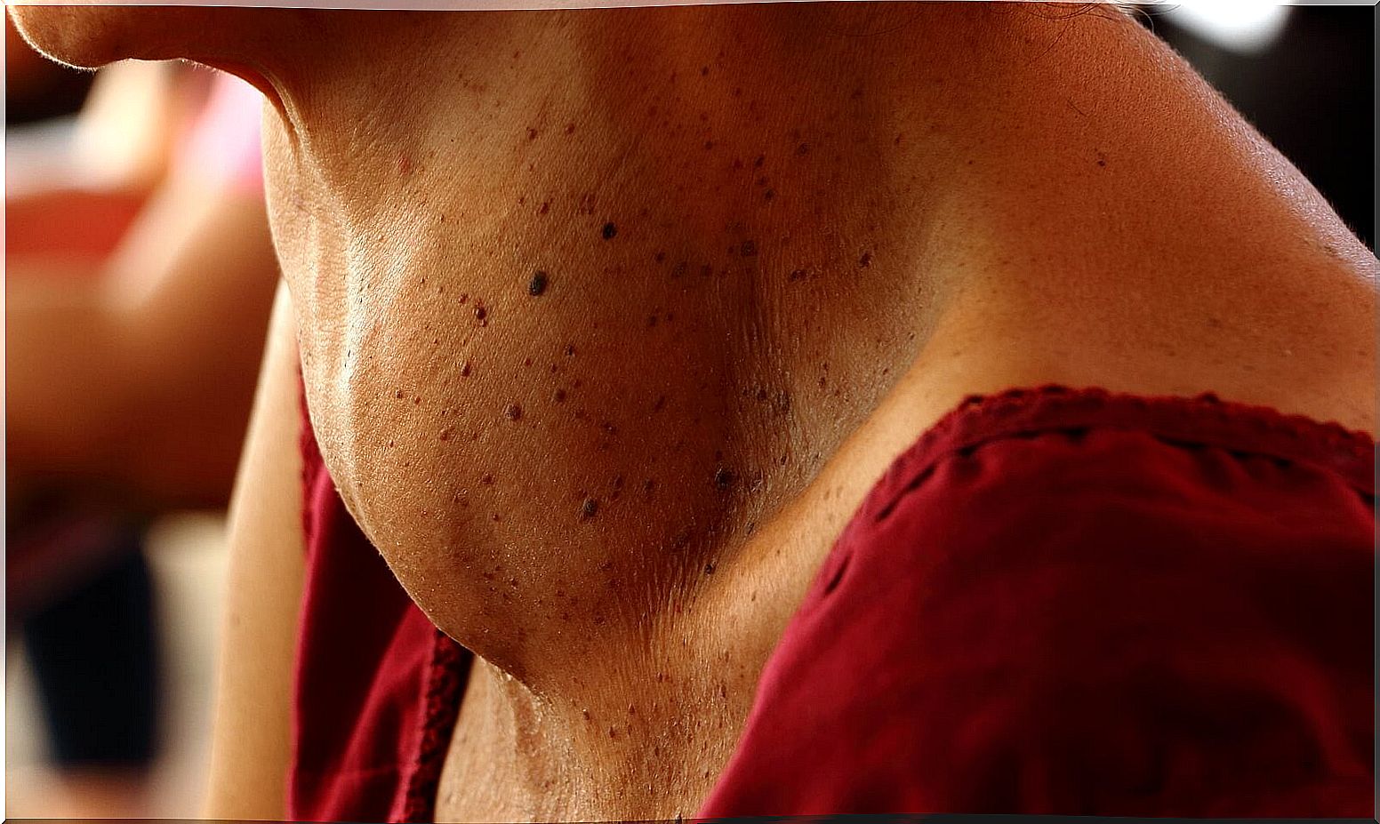 Goiter due to excess iodine in algae.